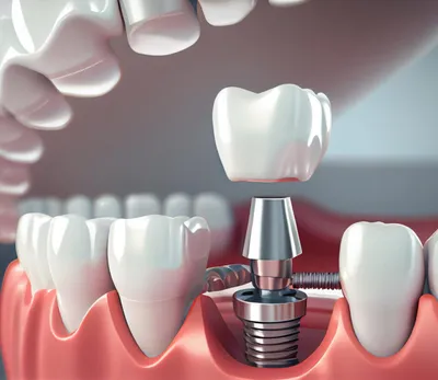 Цена имплантации 1 зуба в Москве, стоимость под ключ в Дантистофф