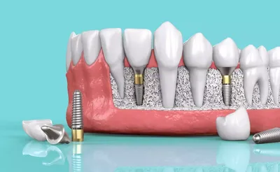 Имплантация зубов в Перми - Стоматология Visual Dental