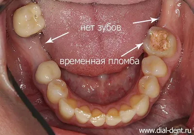 Кому нужна имплантация — стоматология Лукашука на Теремках