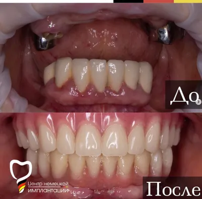 Одномоментная имплантация зубов в Екатеринбурге «под ключ»