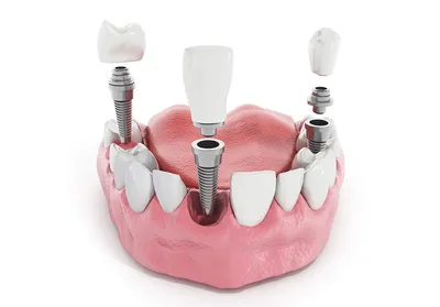 Полная имплантация зубов под ключ (при полном отсутствии зубов) - цена в  Санкт-Петербурге