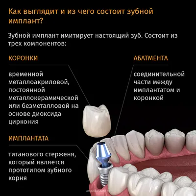 Имплантация зубов цены в Ногинске, стоимость установки зубного имплантата