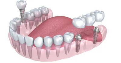 Имплантация зубов в Перми - цена от 28000 на имплант зуба установка под  ключ в стоматологии «ЭСТ»
