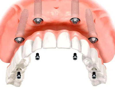 Имплантация зубов на верхней челюсти