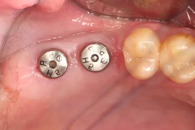 Установка зубных имплантов пошагово с фото и видео, этапы имплантации зубов