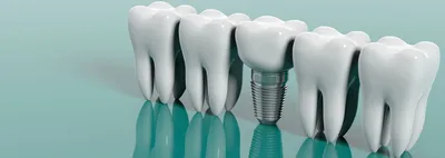 Экспертная имплантация зубов в Рассвете | Клиника Рассвет