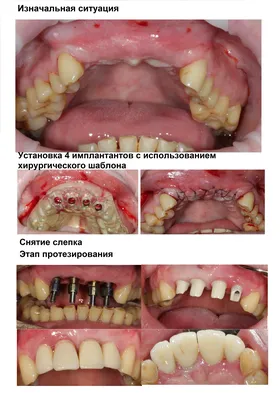 Имплантация зуба после удаления | НК Клиник