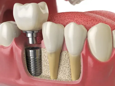 5 мифов об имплантации зубов | Новость