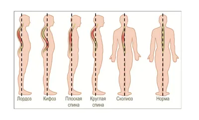 Симптомы искривление позвоночника