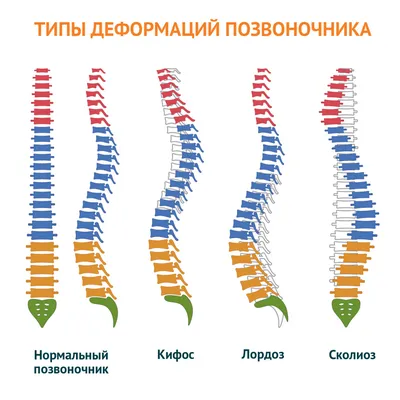 Искривление позвоночника лечение, сколиоз