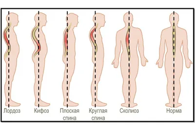 Сколиоз, виды искривления позвоночника у детей и взрослых, лечение сколиоза  в Москве