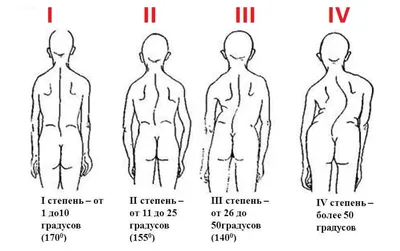 Почему искривляется поясничный отдел позвоночника. Доктор Позвонков