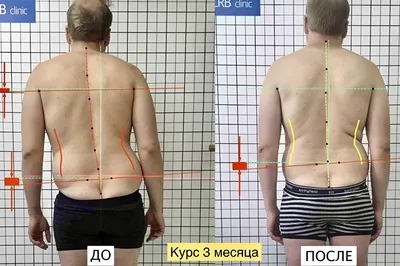 В Кировской областной травмбольнице проходят сложнейшие операции по  исправлению деформаций позвоночника у детей. » ГТРК Вятка - новости Кирова  и Кировской области