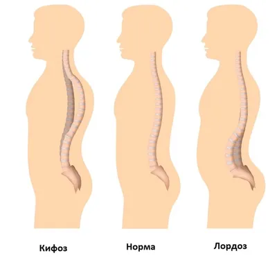 Когда искривление поражает шейный отдел позвоночника. Доктор Позвонков