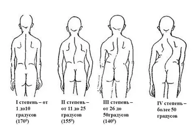 Искривления позвоночника картинки