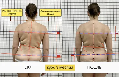 Коррекция сколиоза у детей и подростков | Консультативно-диагностическая  поликлиника ivp clinic