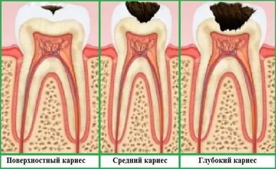 Острый кариес: симптомы, причины, лечение, профилактика, фото острого  кариеса, цены в Москве