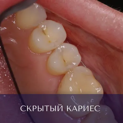 Средний кариес