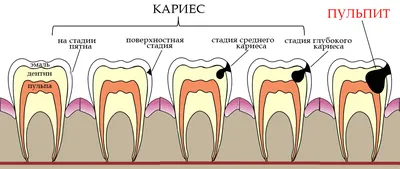 Лечение кариеса в Челябинске | Дента