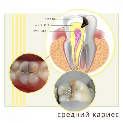 Виды кариеса и как выглядит кариес на зубах и на рентгене - реальные фото