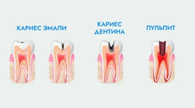 Межзубный кариес: лечение и профилактика, причины и симптомы кариеса между  передними зубами, цены в Москве