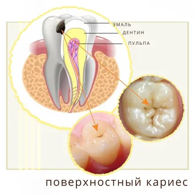 Глубокий кариес: симптомы и методы лечения зубов препаратами