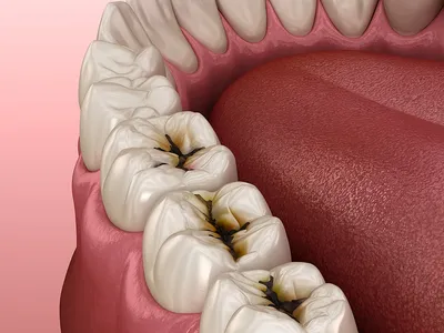 Прикорневой кариес: лечение и профилактика, причины и симптомы, цены в  Москве