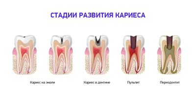 Кариес по Блэку - классификация, виды, лечение кариеса