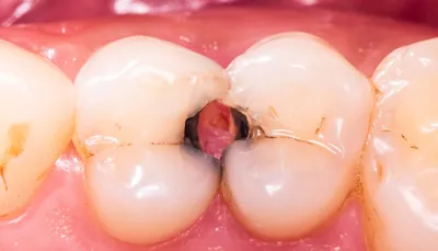 Кариес зубов | Признаки и диагностика кариеса зубов