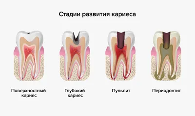 Средний кариес: симптомы и методы лечения постоянных зубов