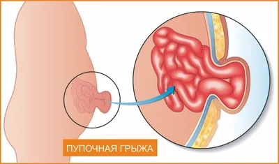 Киста копчика (эпителиальный копчиковый ход) | Цена операции в Украине