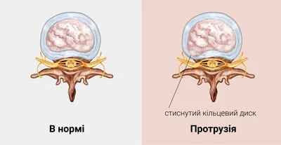 ᐈ Что такое протрузия дисков? ~【Лечение в Киеве】