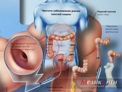 Особенности правильной очистки кишечника разными методами.