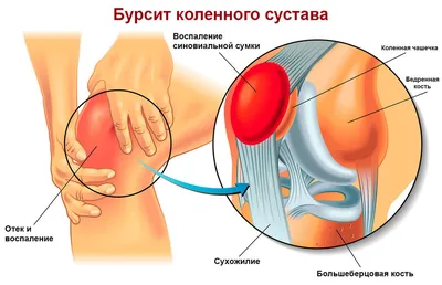 Бандаж на колено с силиконовым кольцом NKN-209 - купить по выгодной цене |  Доктор Плюс