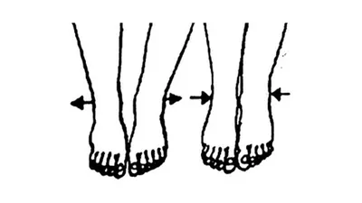 Центр здоровья ног / Плоскостопие - Pes planus