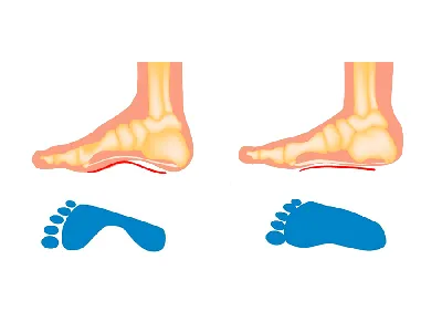 Плоскостопие: степени, лечение и профилактика, симптомы у взрослых и детей