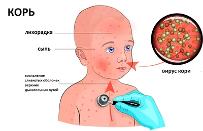 Симптомы кори и способы её лечения — блог медицинского центра ОН Клиник