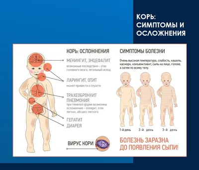 Корь: причины, симптомы, стадии развития, диагностика, прогноз