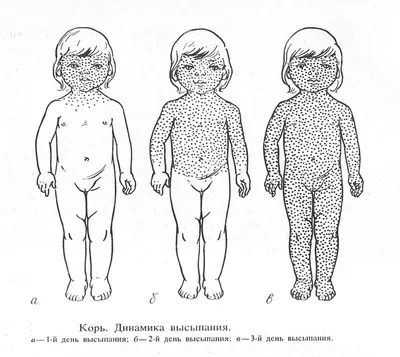 Корь: в зоне риска не только дети