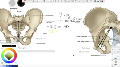 Аутокость и 3D-импланты. Специалисты Онкоцентра творят чудеса при  реконструкции поражённых опухолью костей таза.. ФГБУ «НМИЦ онкологии им.  Н.Н. Блохина» Минздрава России