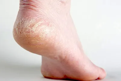 Кожные заболевания ног картинки
