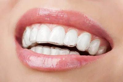 Красивая улыбка за один день — это реально! — Стоматология «Доктор НеболитЪ»