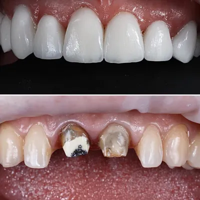 Полное восстановление зубов на нижней и верхней челюсти за 1 месяц |  