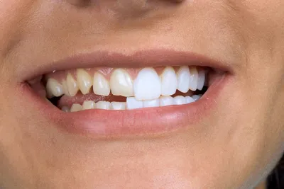 РИЦА, Волжский: Восстановление зубов, красивая улыбка