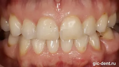 Хочу ровные зубы! Какие варианты лечения может предложить современная  стоматология? - "Фортуна"