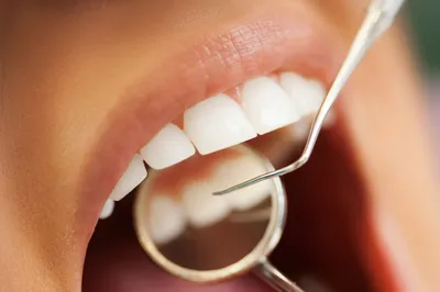 8 вопросов о восстановлении красивых зубов