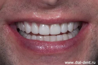 Совместная работа стоматолога-ортопеда и ортодонта для создания красивой  мужской улыбки