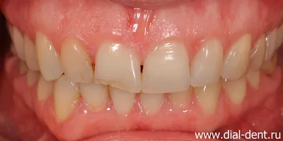 Белые красивые зубы: как реализовать мечту?
