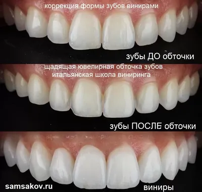 Сделайте мне красиво: тренд на украшения для зубов возвращается - Красота -  