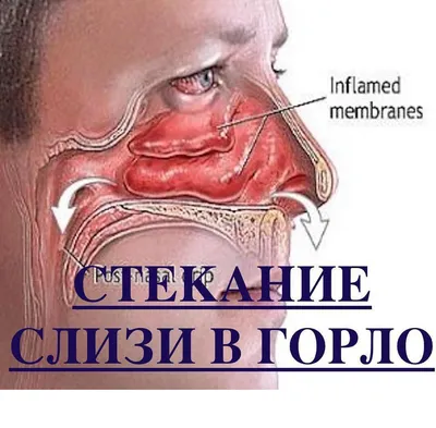 Красные точки на небе у взрослого и ребенка – 1 стоматологическая причина и  10 дополнительных